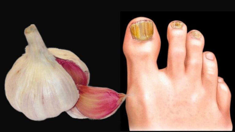 This simple remedy vanishes nail fungus almost instantly… you’ll want to try it!