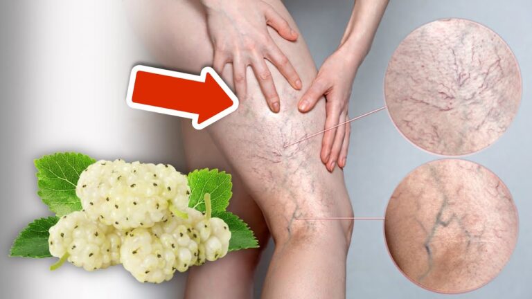 5 Surprising Fruits That Can Help Make Varicose Veins Disappear! 🍇✨