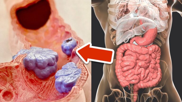 6 Proven Ways to Dramatically Lower Your Colon Cancer Risk Today!