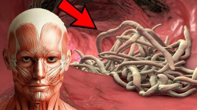 7 Signs Your Body Is Full of Parasites – Discover the Facts You Need to Know!