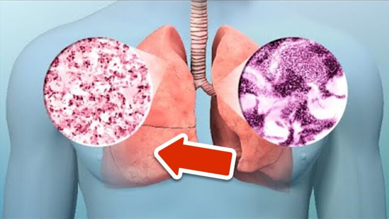 8 Warning Signs of Lung Cancer You Should Never Ignore – Discover the Key Symptoms!