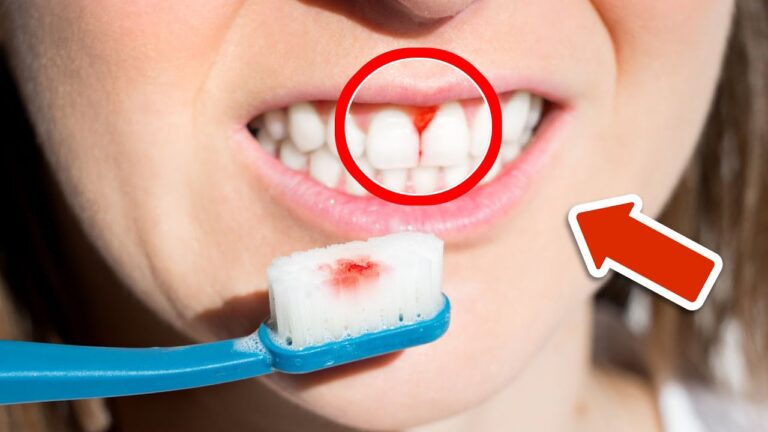 Discover 7 Shocking Reasons for Gum Bleeding You Didn’t Know About!