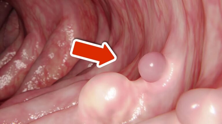 8 Critical Symptoms of Colon Cancer You Must Not Ignore for Your Health