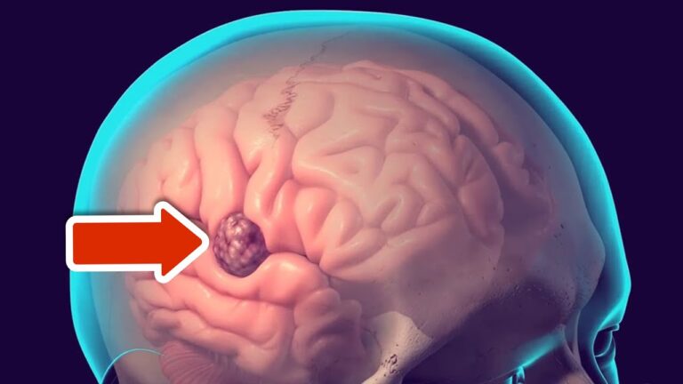 6 Warning Signs of a Brain Tumor You Must Not Ignore for Your Health!