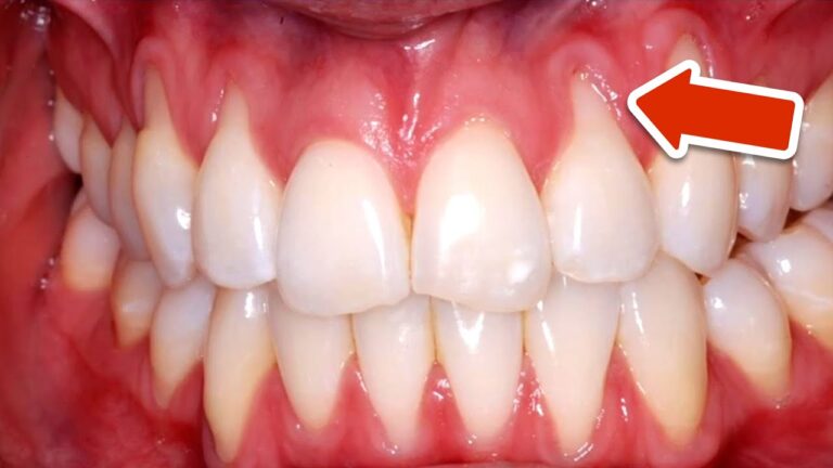 Stop Gum Recession: 5 Simple Solutions to Restore Your Smile Today!