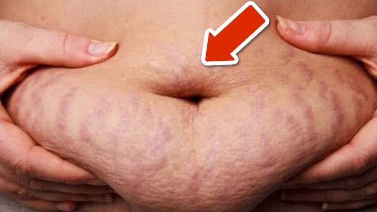 5 Simple Ways to Get Rid of Stretch Marks Fast You Won’t Believe!